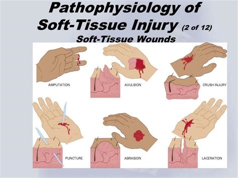 how to test for soft tissue damage|grade 1 soft tissue damage.